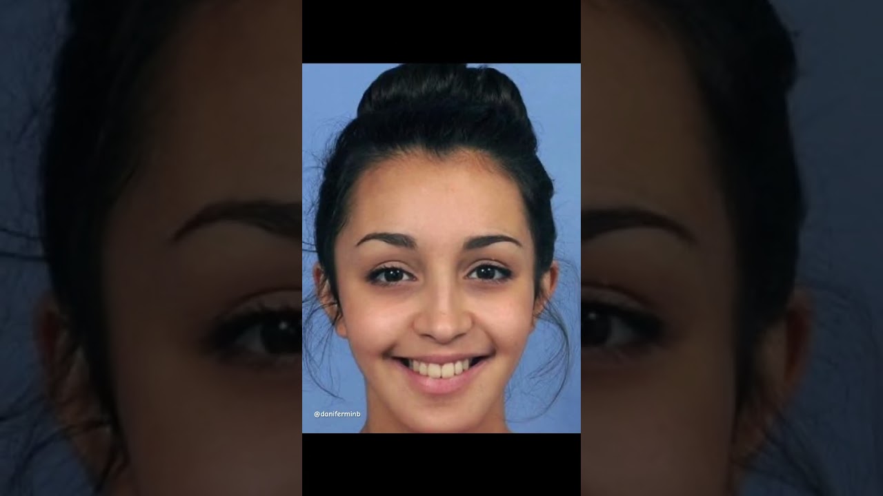 cara labios antes y despues de los brackets
