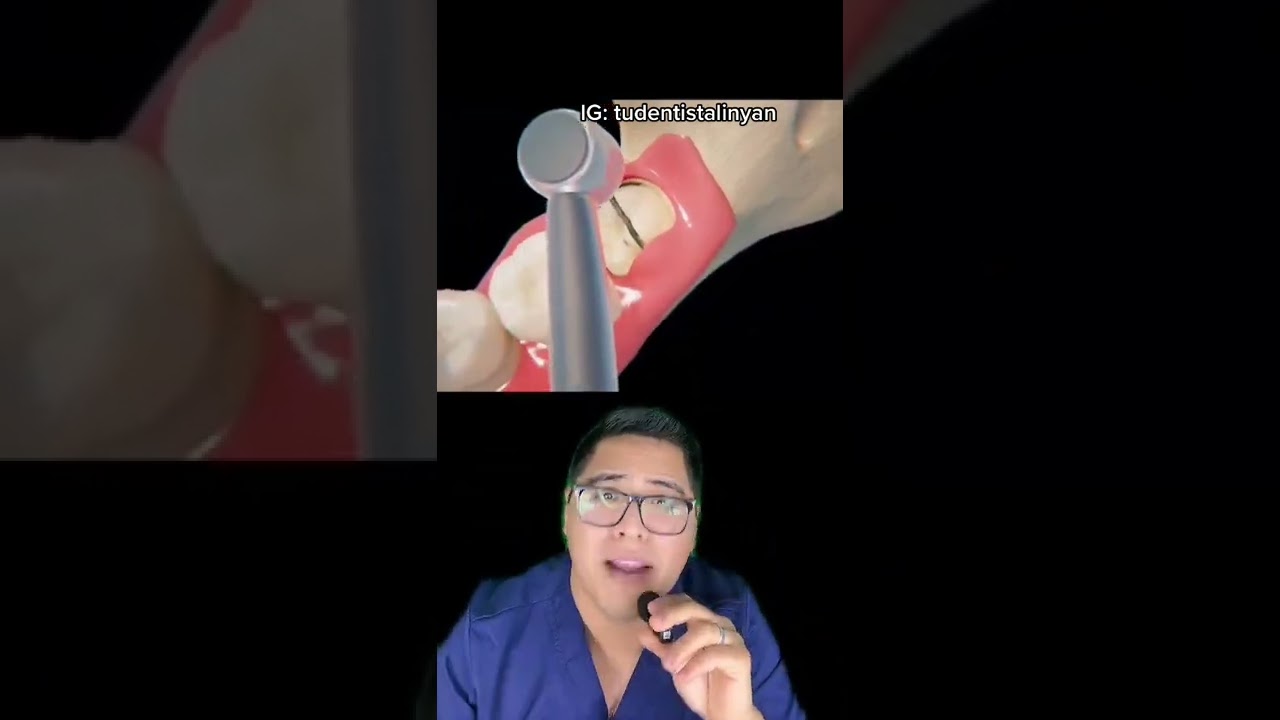 caries en la muela del juicio