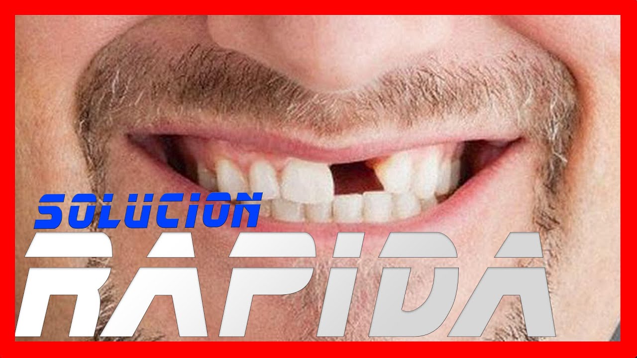 como arreglar un diente roto sin ir al dentista
