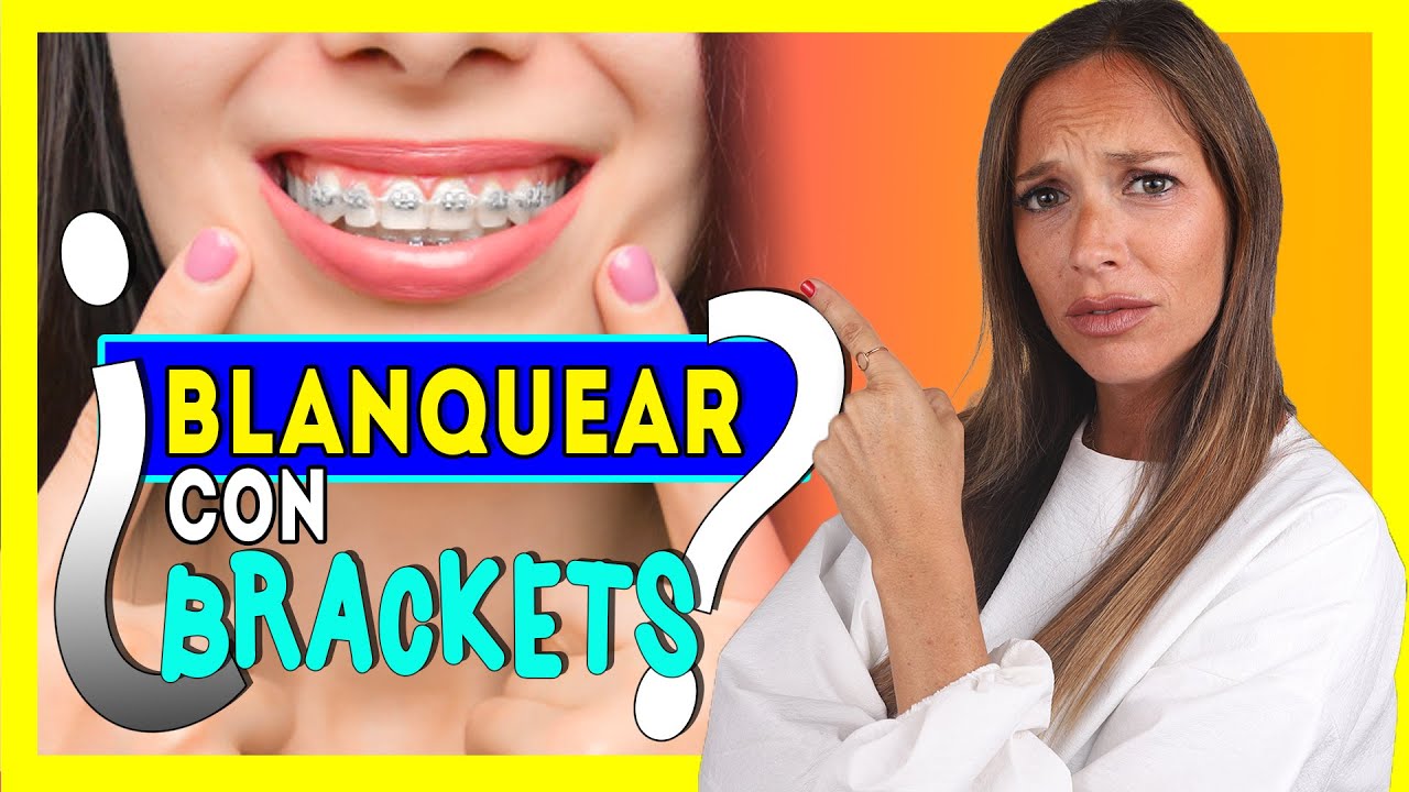 como blanquear los dientes con brackets