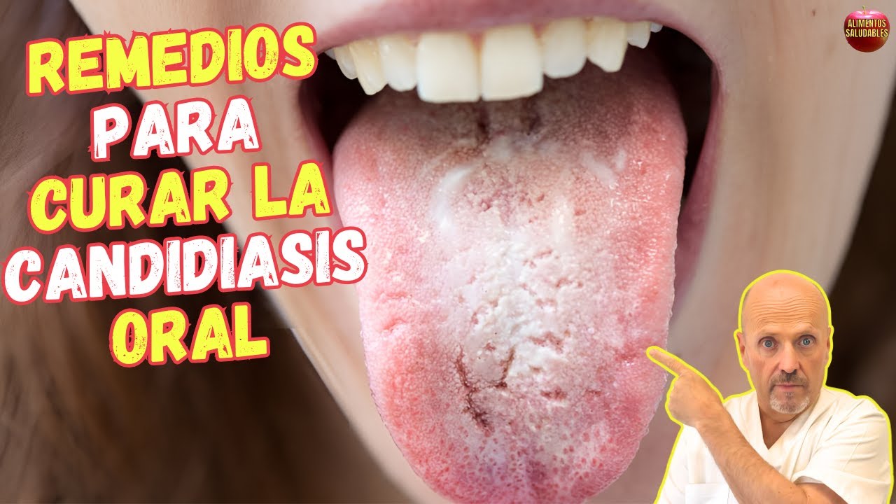 como curar la candidiasis en la boca