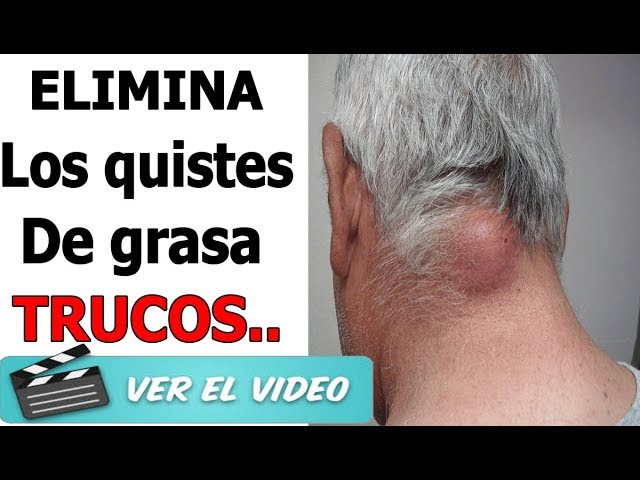 como quitar un quiste de grasa