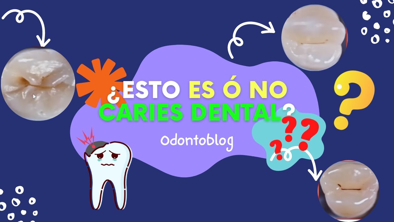 como saber si es una caries o una mancha