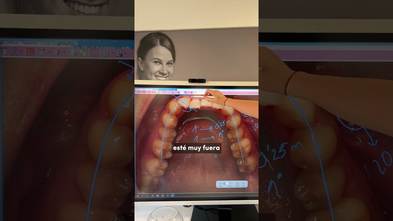 cuanto cuesta el invisalign en españa