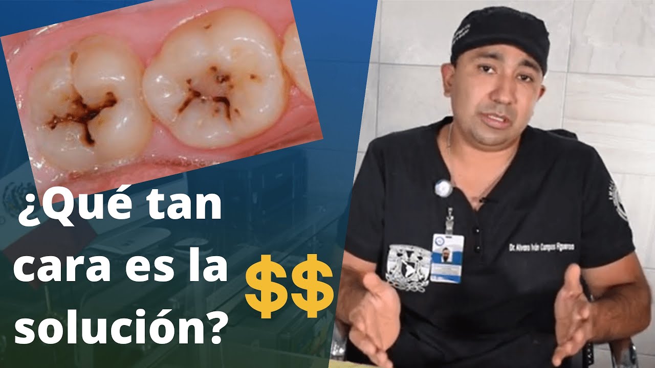 cuanto cuesta un empaste de una muela