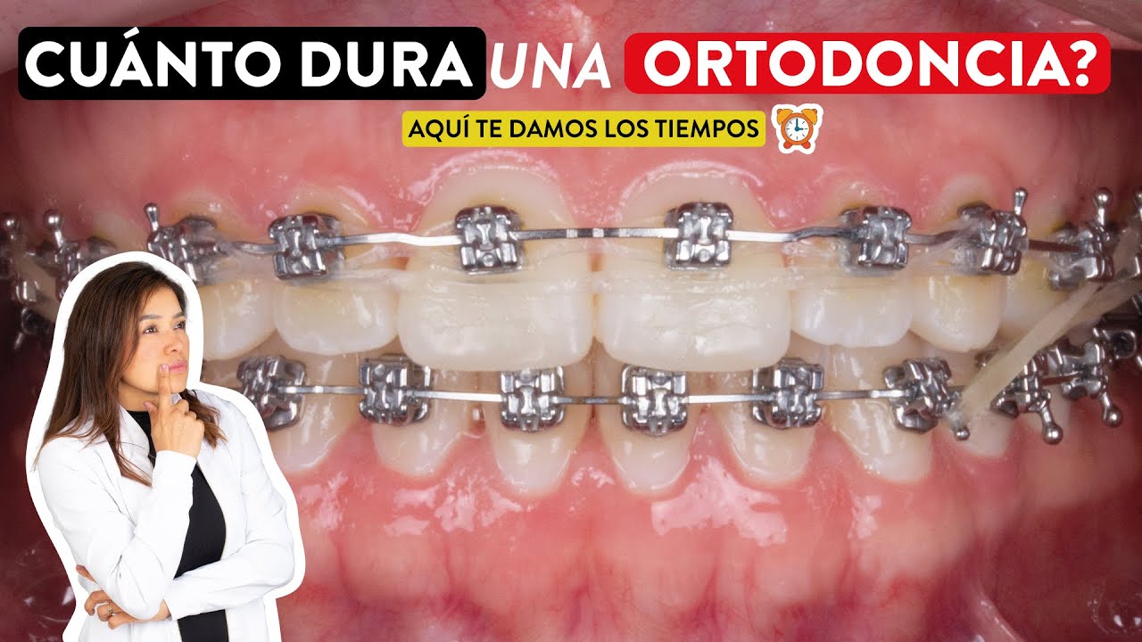 cuanto dura una ortodoncia en adultos