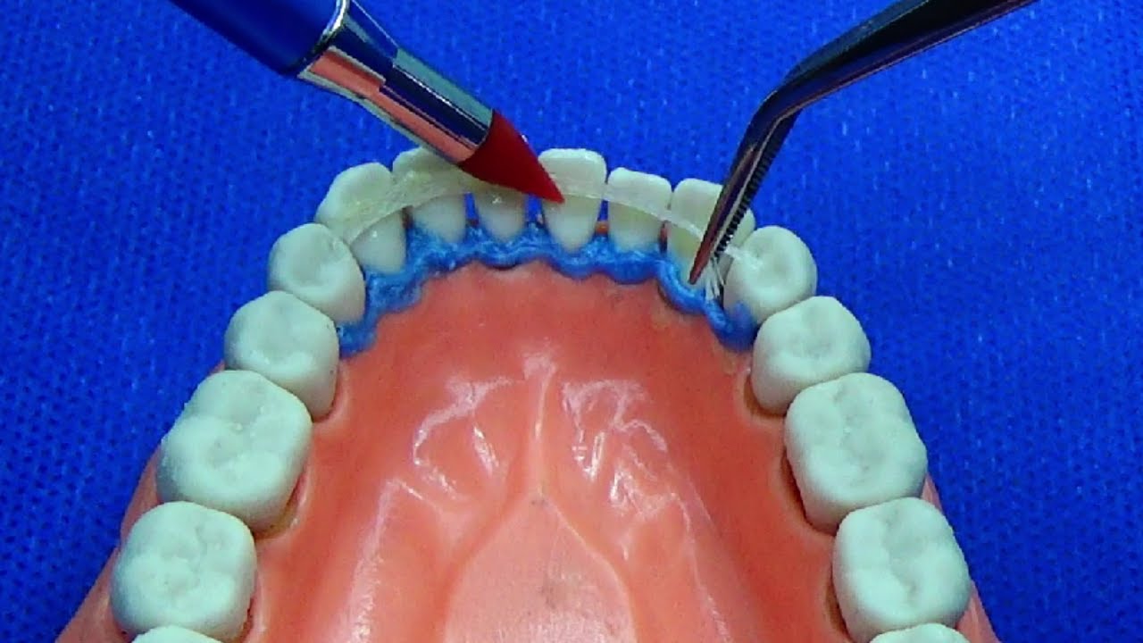 dientes flojos ferulizacion periodontal con alambre