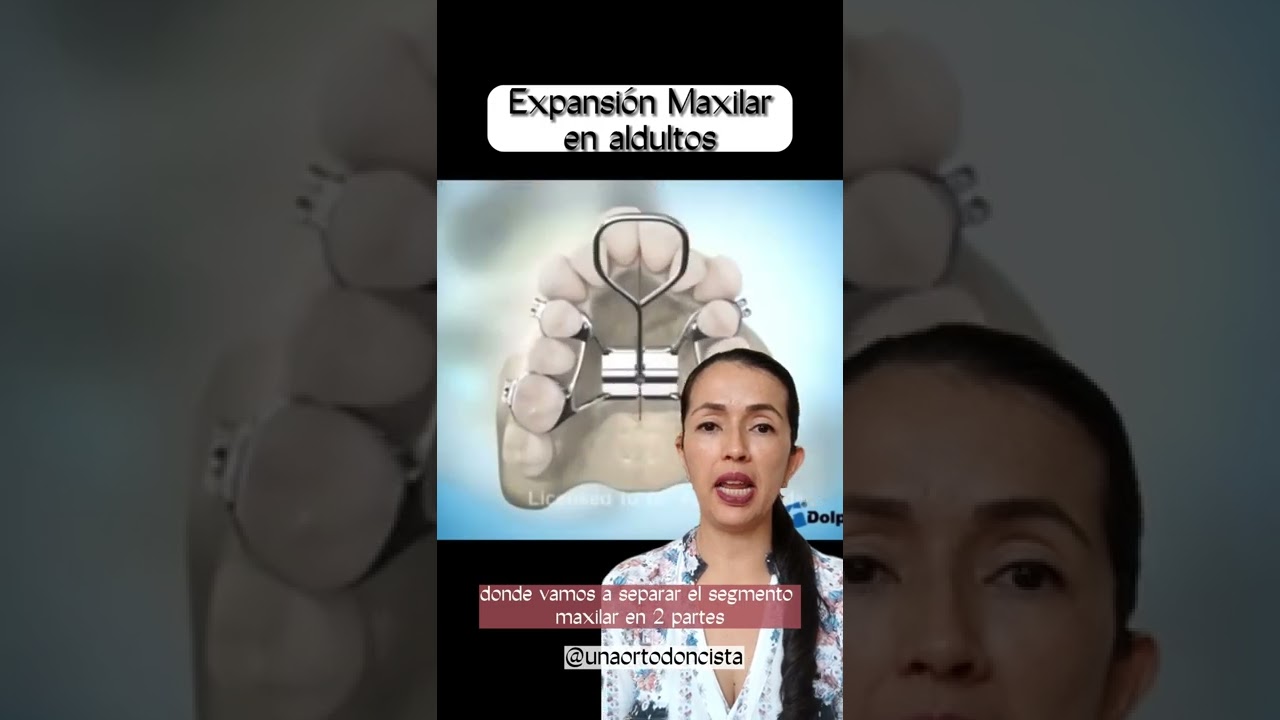 expansor de paladar en adultos tiempo