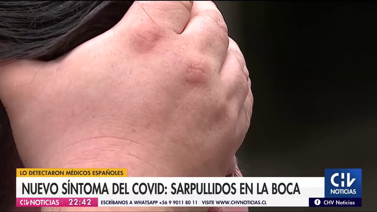 fiebre y llagas en la boca covid