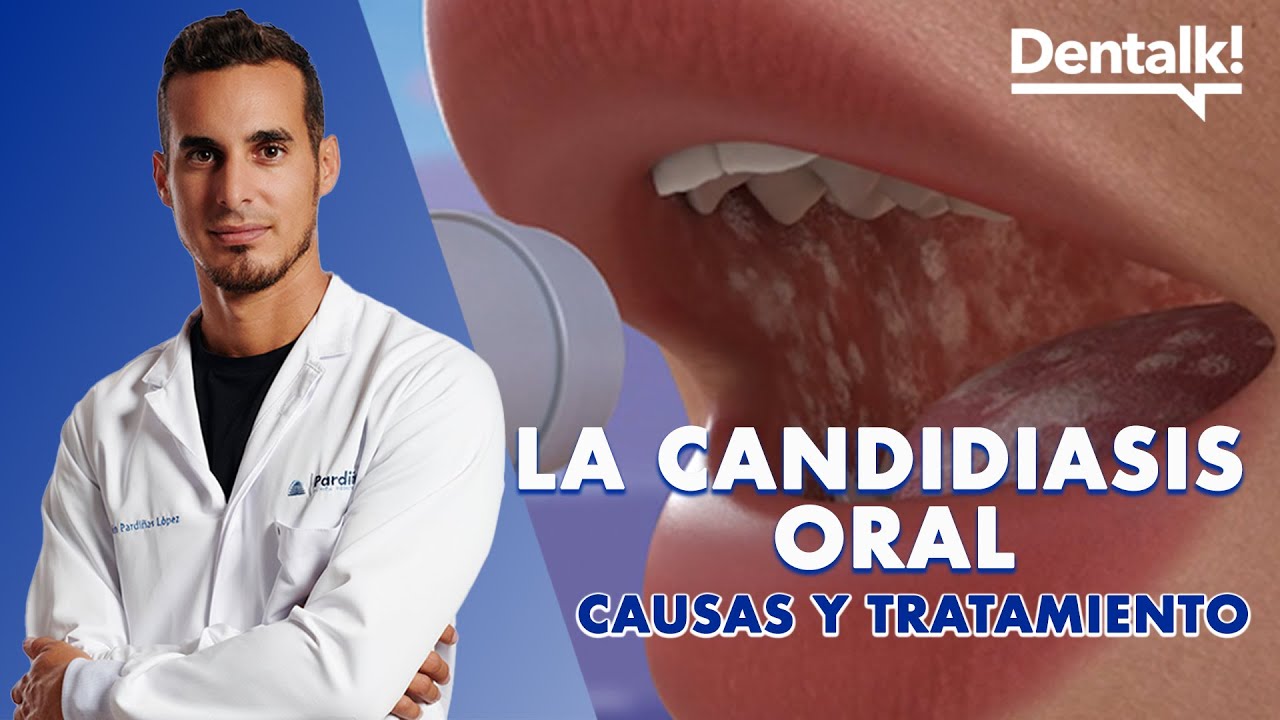 hongos por antibióticos en la boca