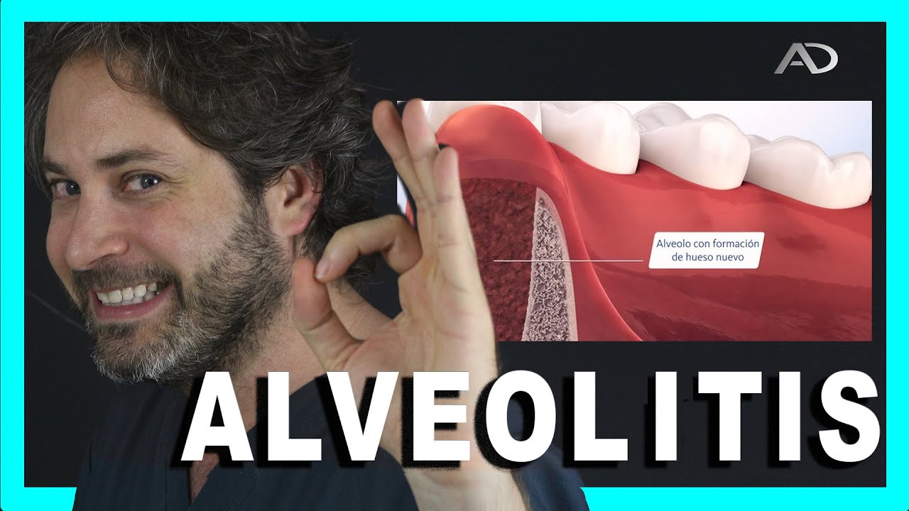 la alveolitis se puede curar sola