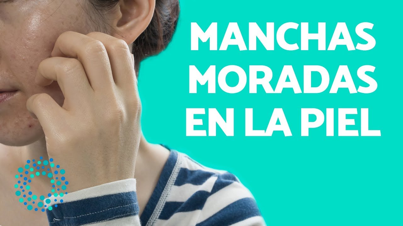 manchas moradas en la piel sin dolor
