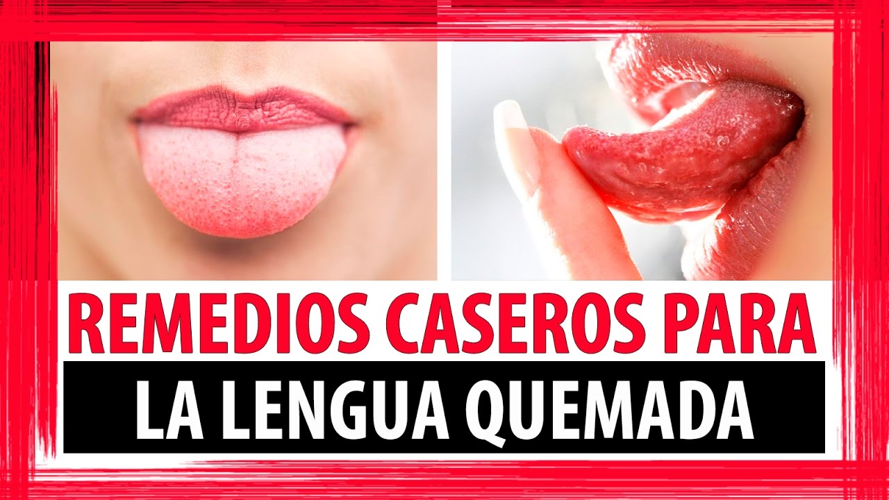 me he quemado la lengua comiendo