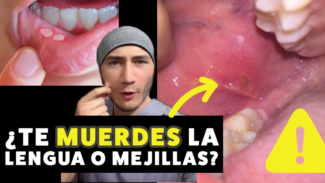 me muerdo la lengua por los lados