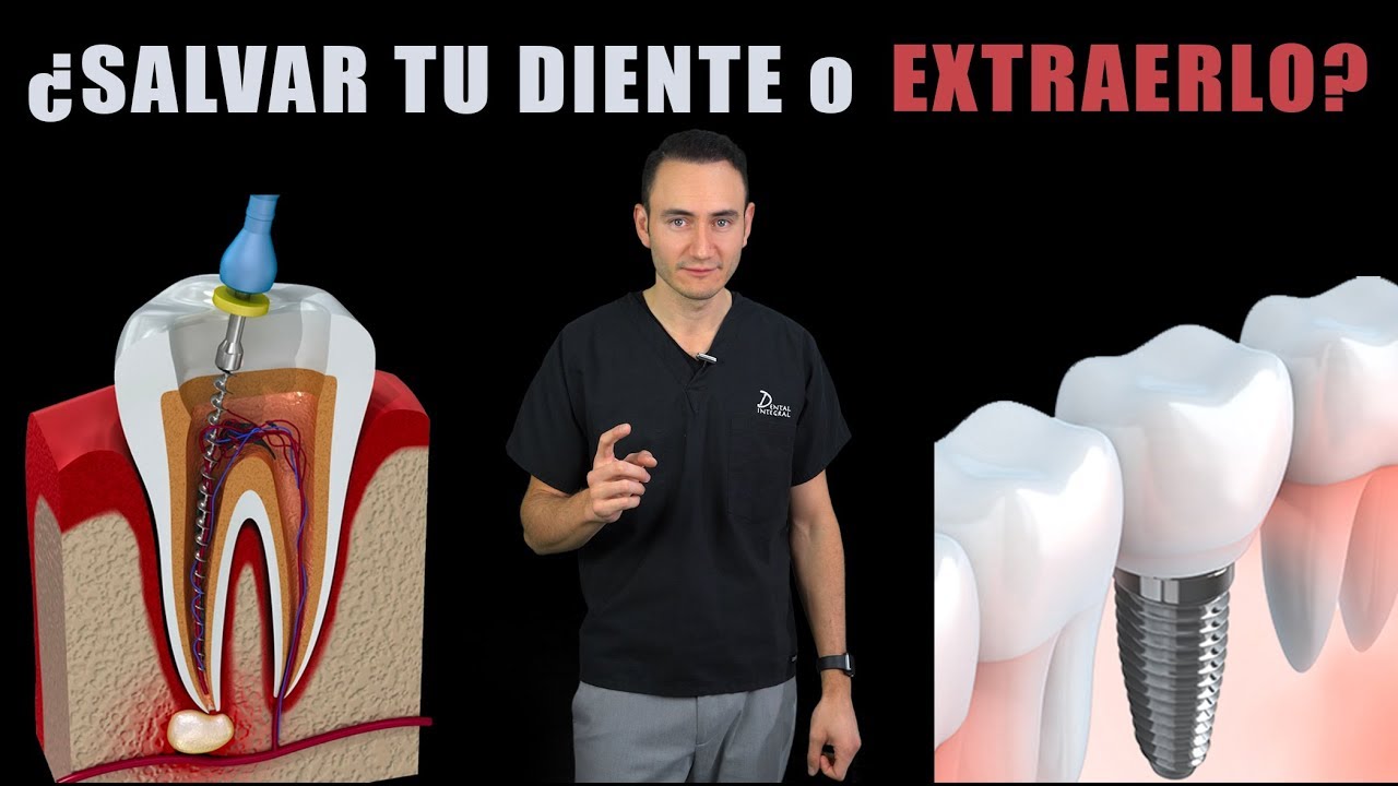 que duele más una endodoncia o un implante