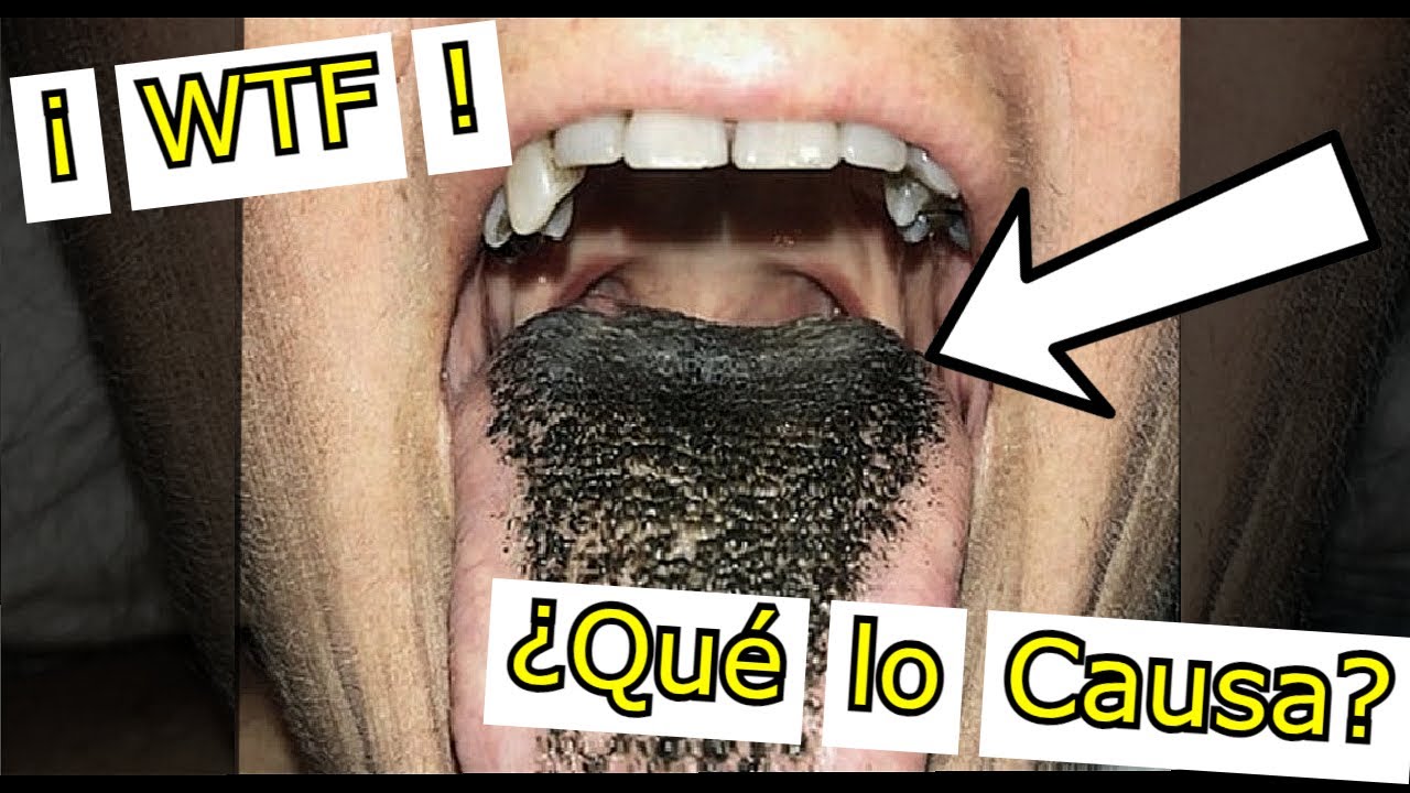 que enfermedad pone la lengua negra