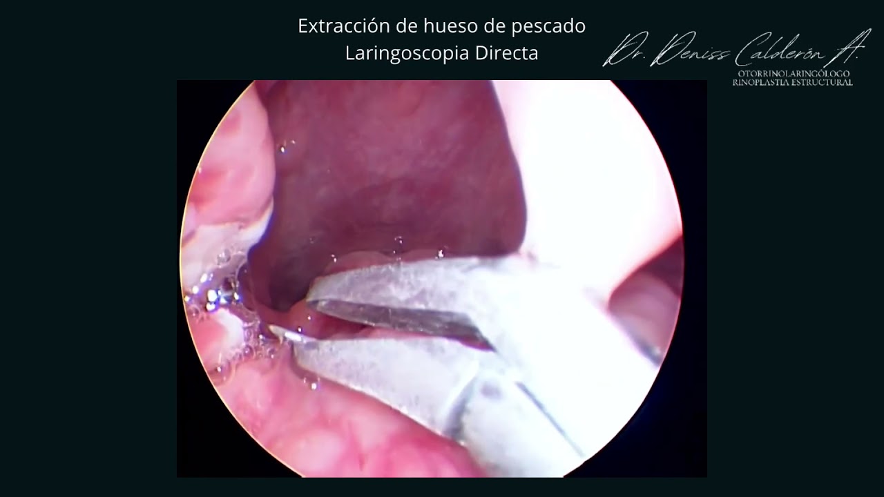 que hacer cuando nos tragamos un hueso