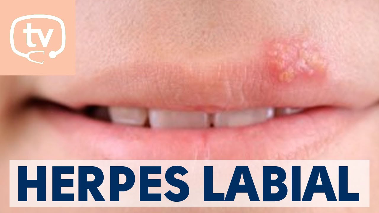 que tomar para el herpes labial