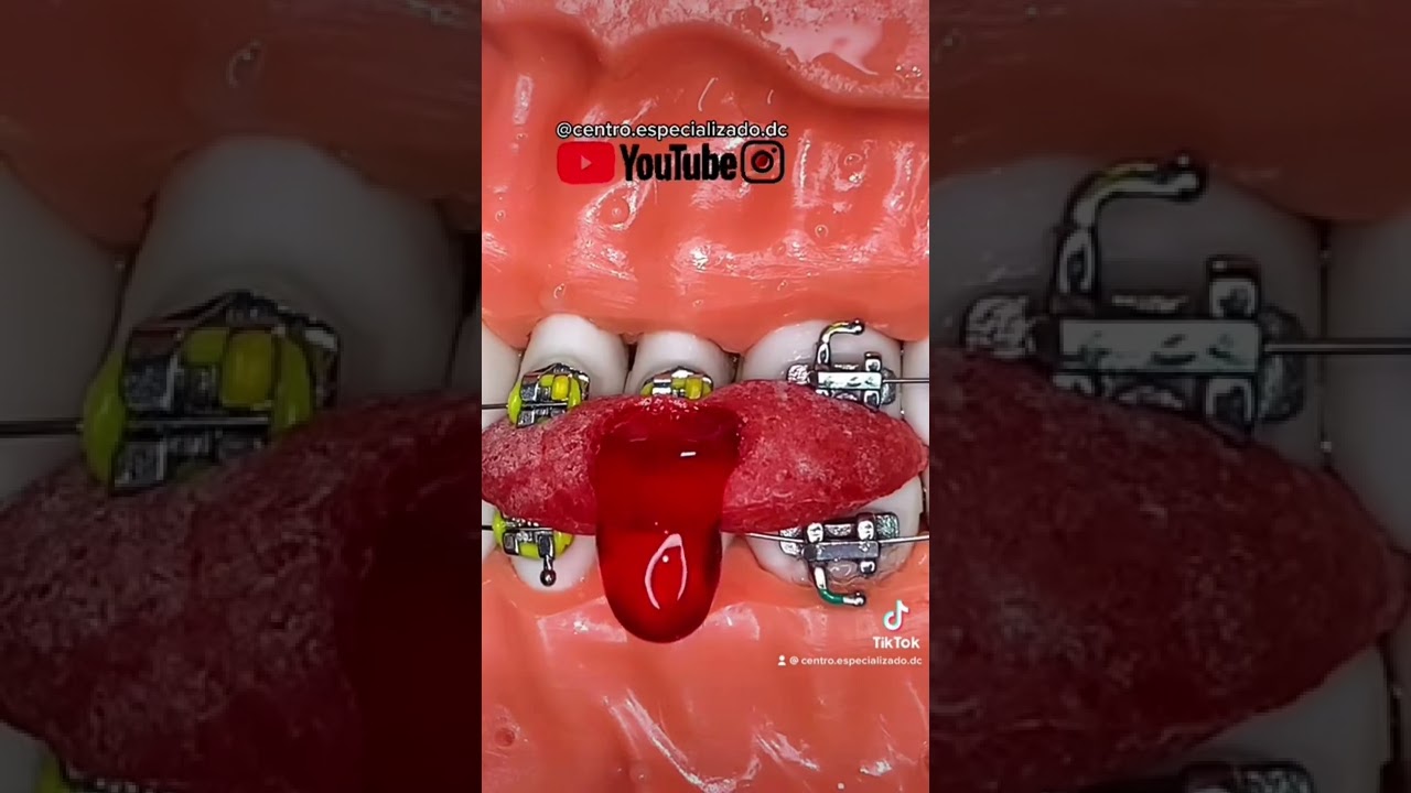 se puede comer chicle con brackets
