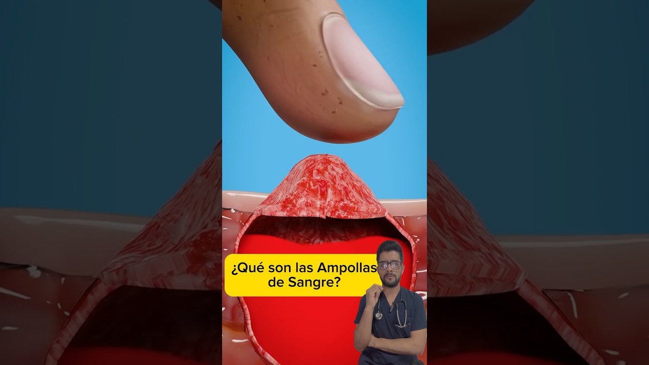 ampollas de sangre en el pie