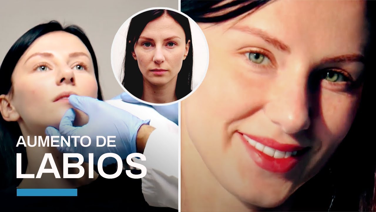 aumento de labios antes y despues