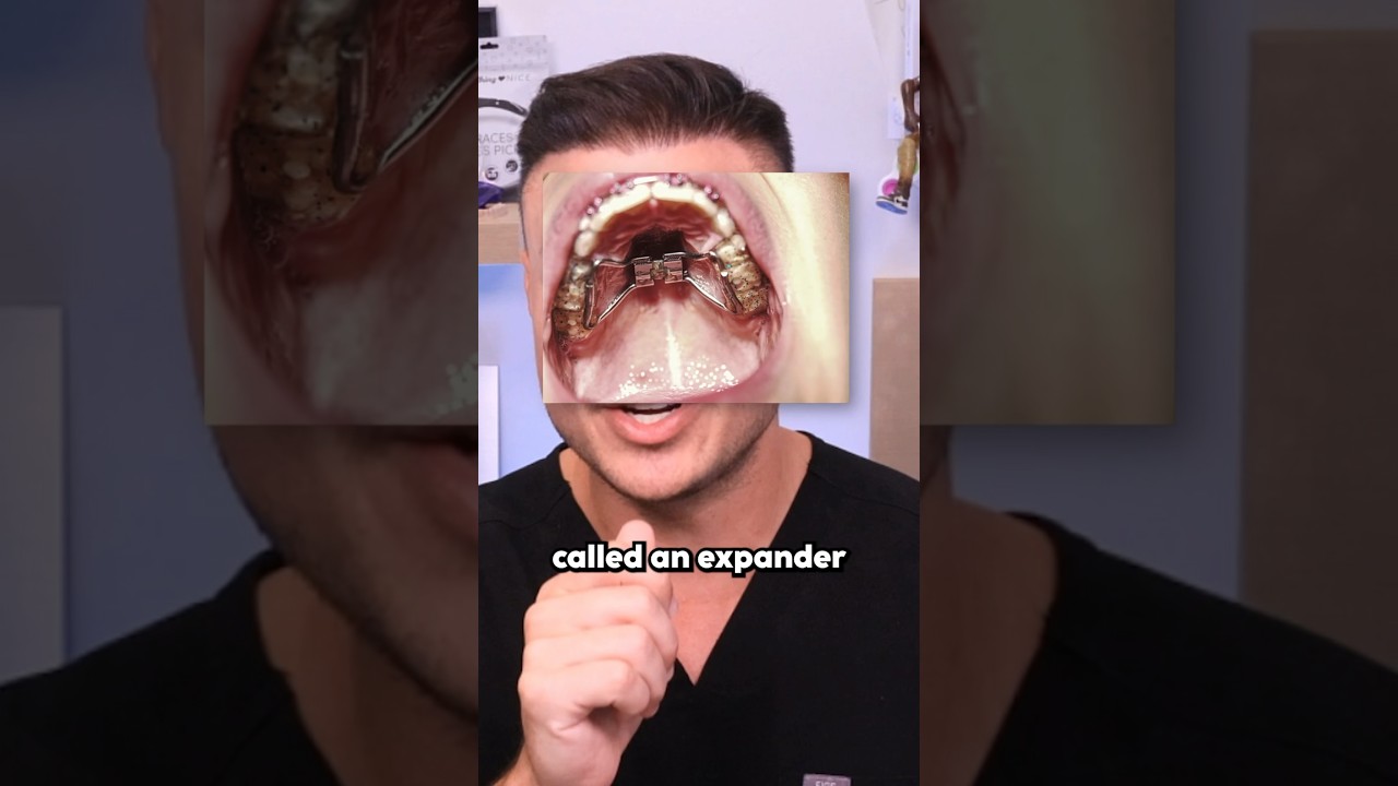 before and after palate expander facial changes