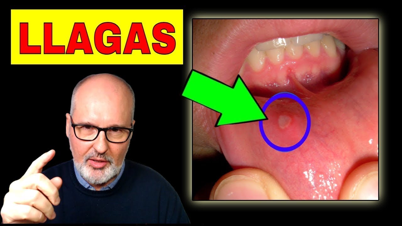 como curar las llagas en el labio