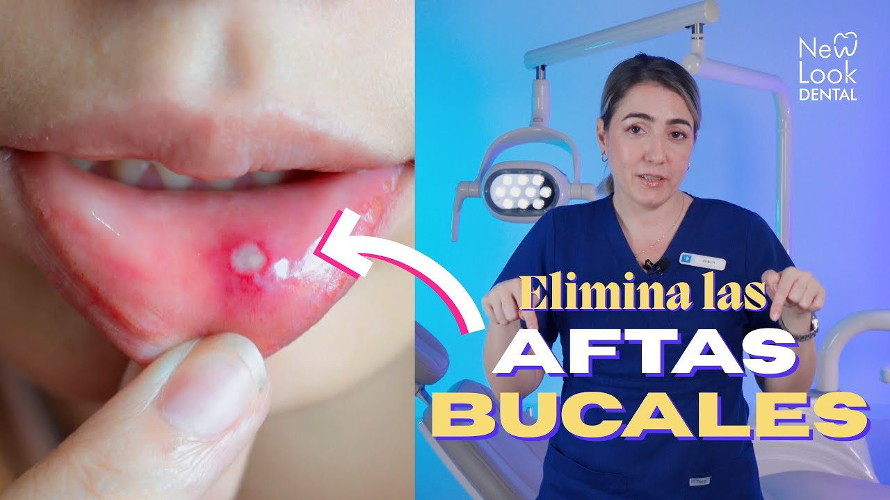 como quitar llagas de la boca rápido