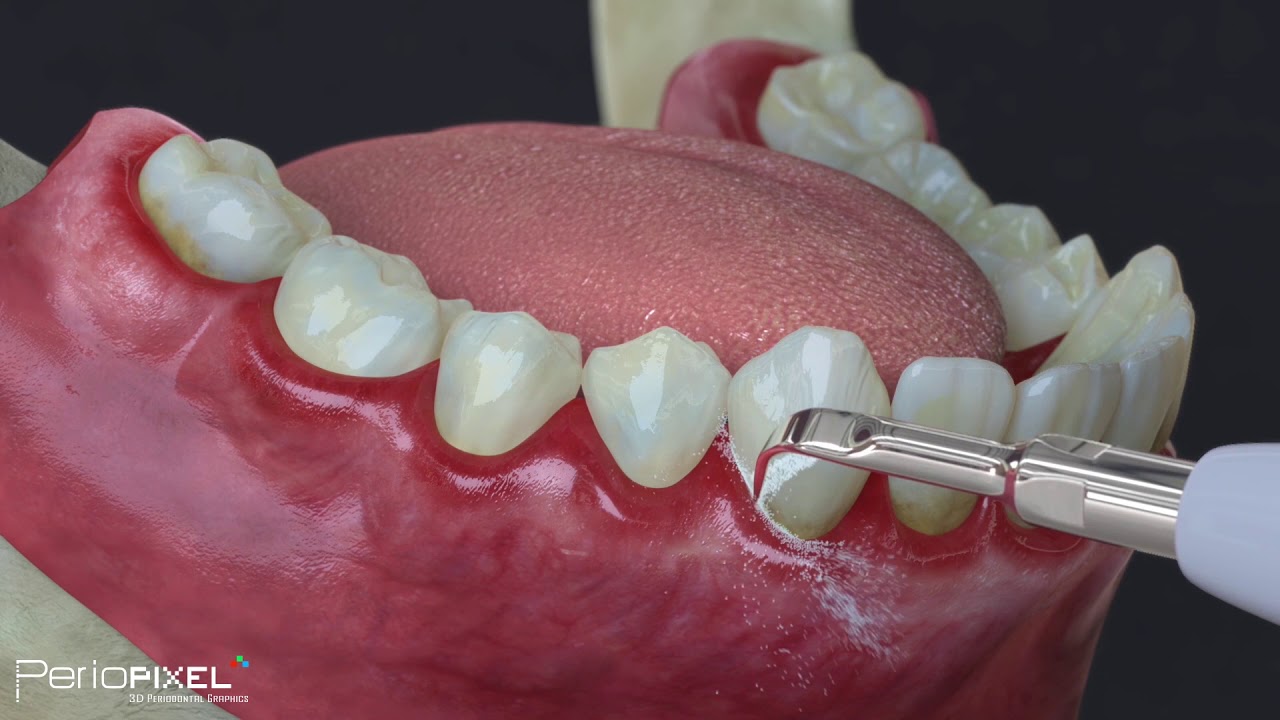 como saber si tengo gingivitis o periodontitis