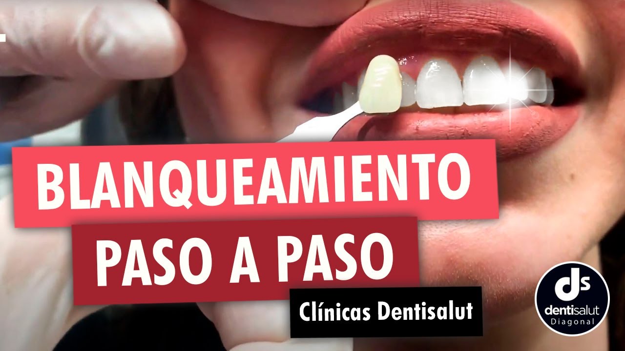 como se hace un blanqueamiento dental