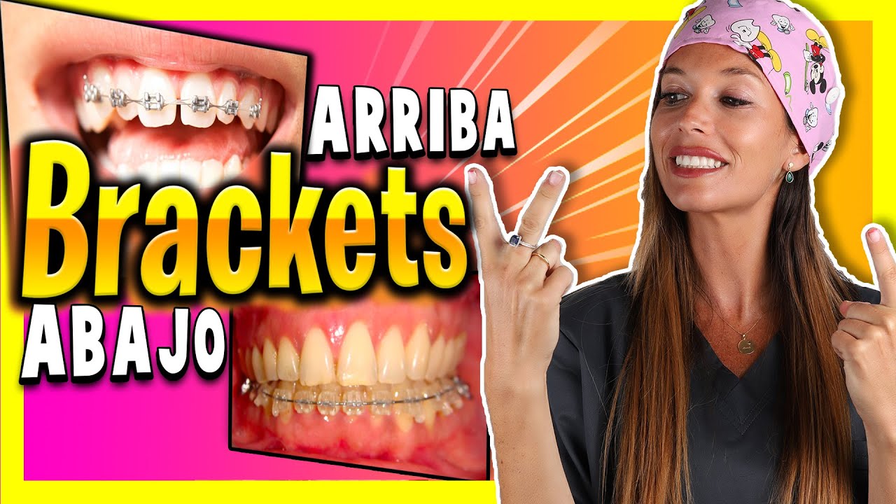 cuanto cuesta ponerse brackets solo abajo