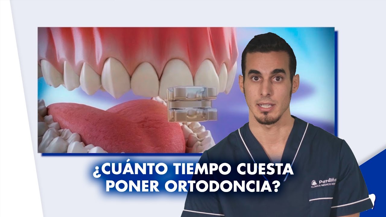 cuanto se tarda en poner brackets