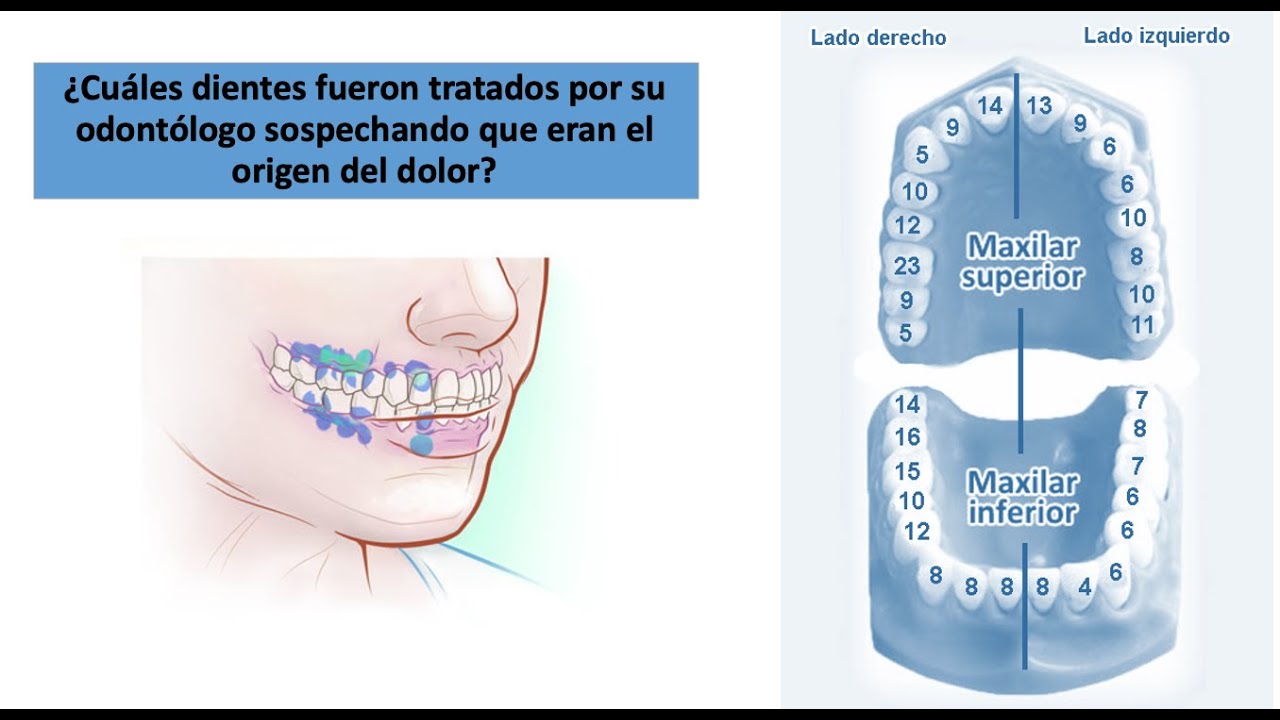 diferencia entre dolor de muelas y neuralgia del trigémino