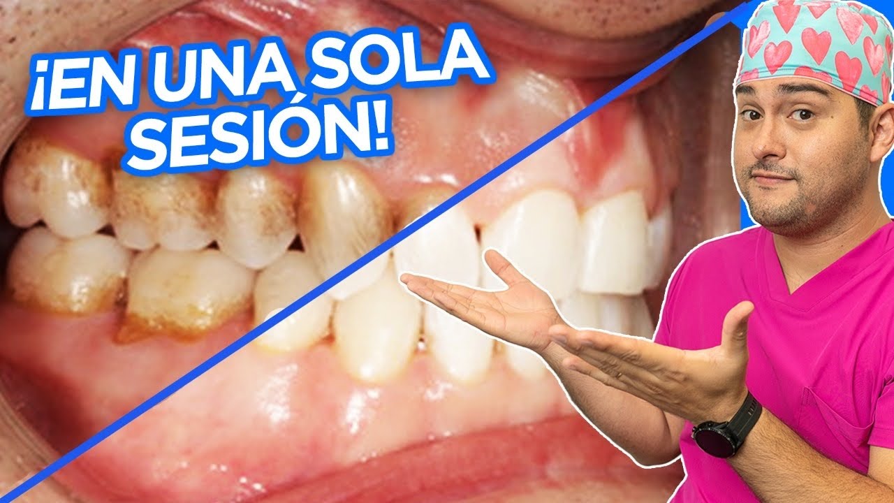 el te verde mancha los dientes