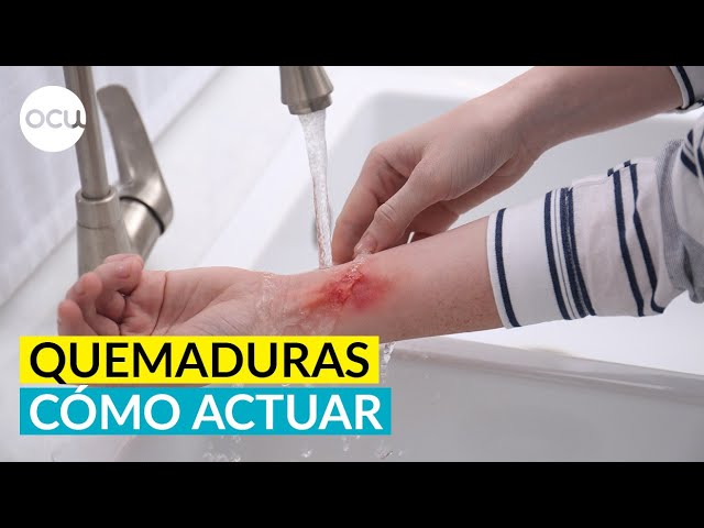 el tomate es bueno para la quemadura