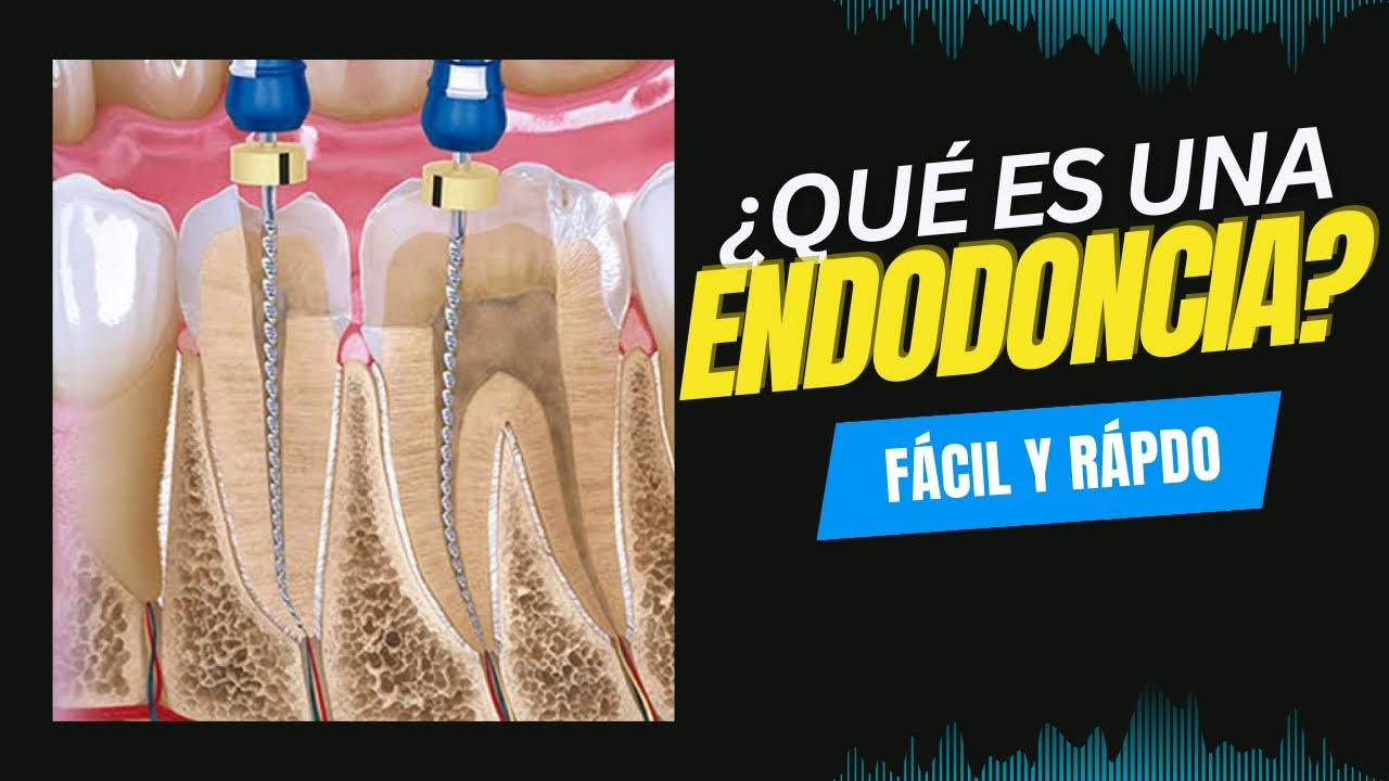 endodoncia que es y para que sirve