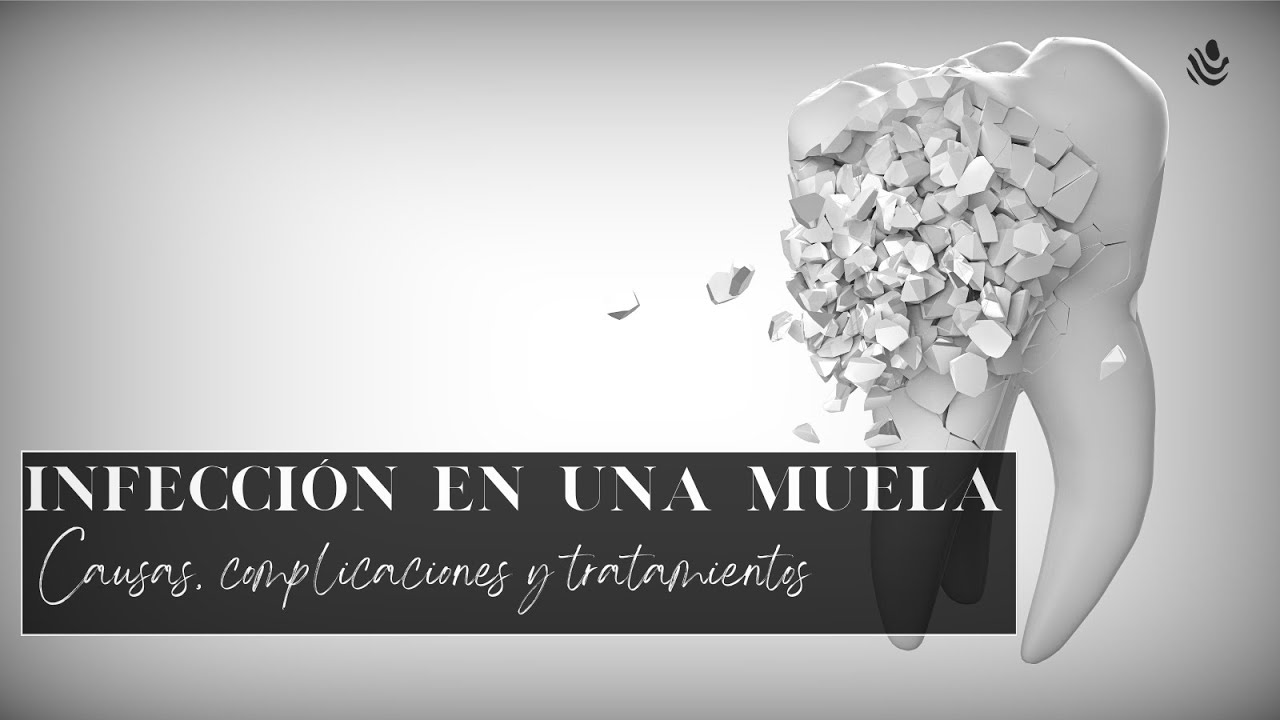infección en una muela que puede desencadenar