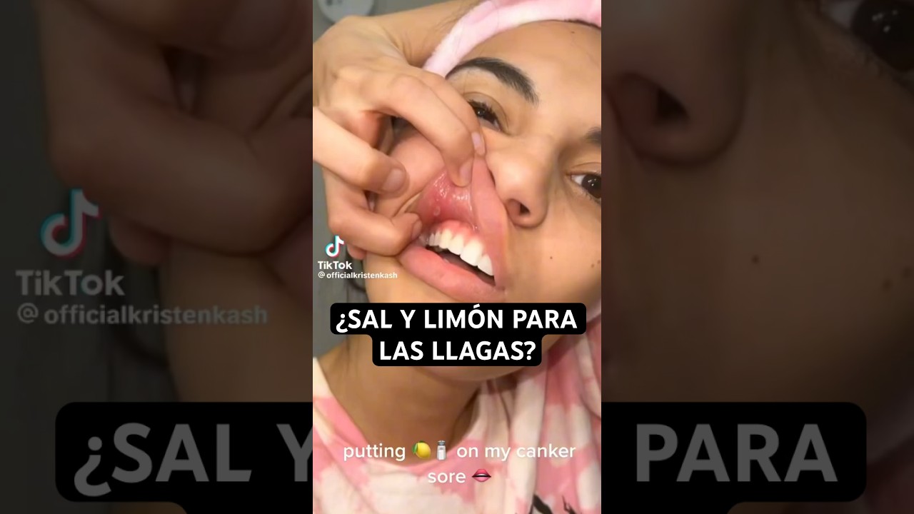 llaga en el labio remedio casero