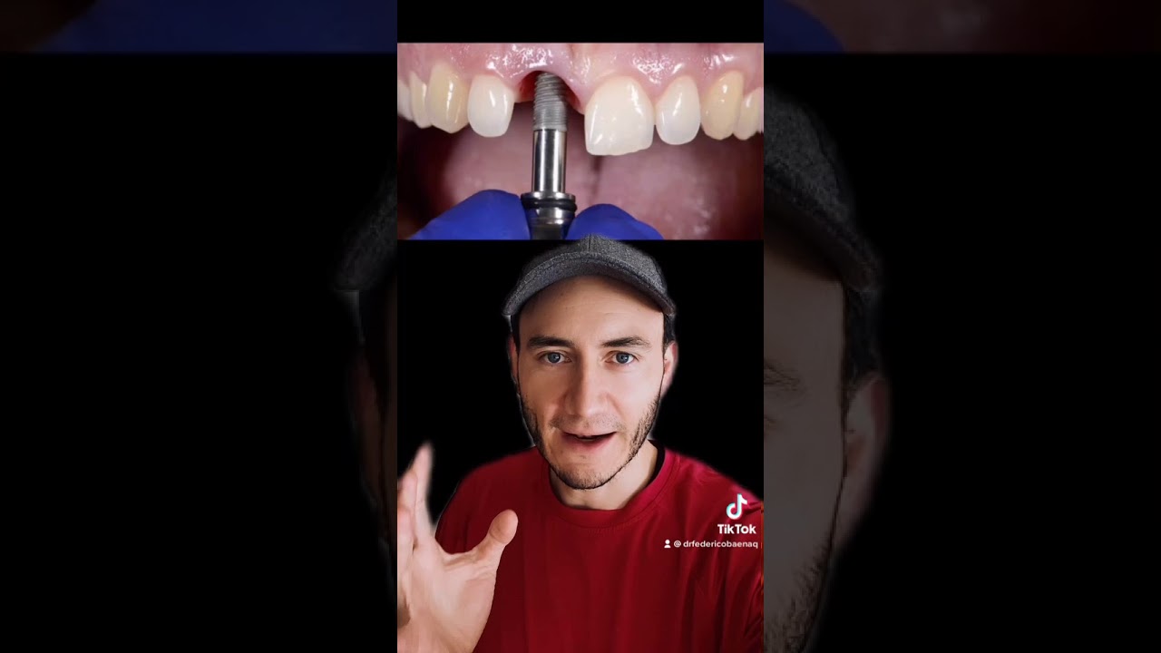 los implantes dentales pitan en el aeropuerto