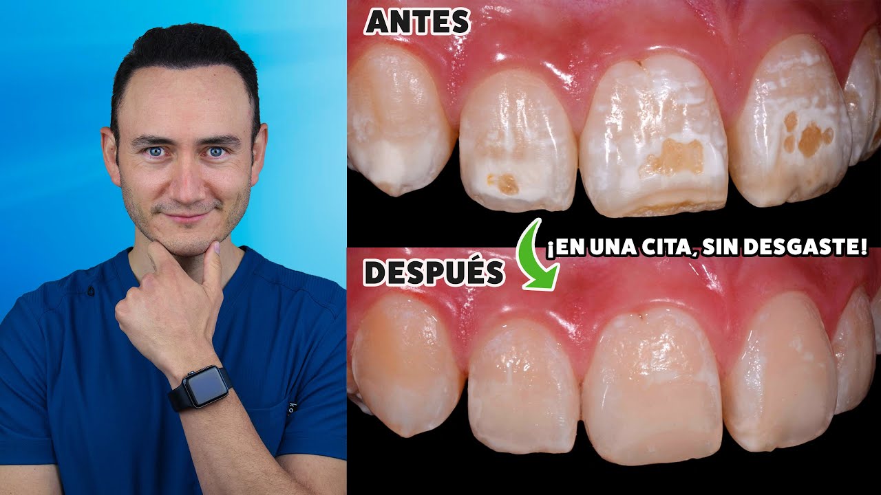 manchas en los dientes como quitarlas