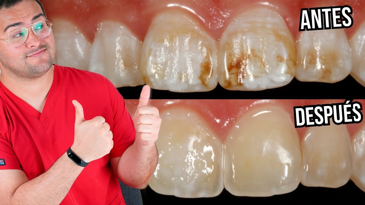 manchas marrones en los dientes como quitarlas
