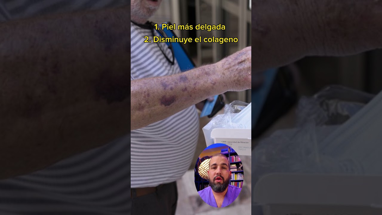 manchas moradas en la piel ancianos