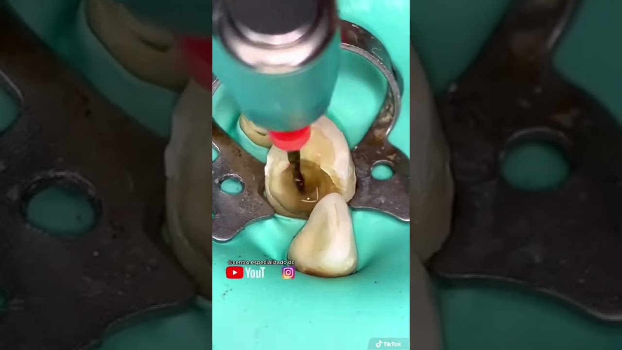 matar el nervio de una muela