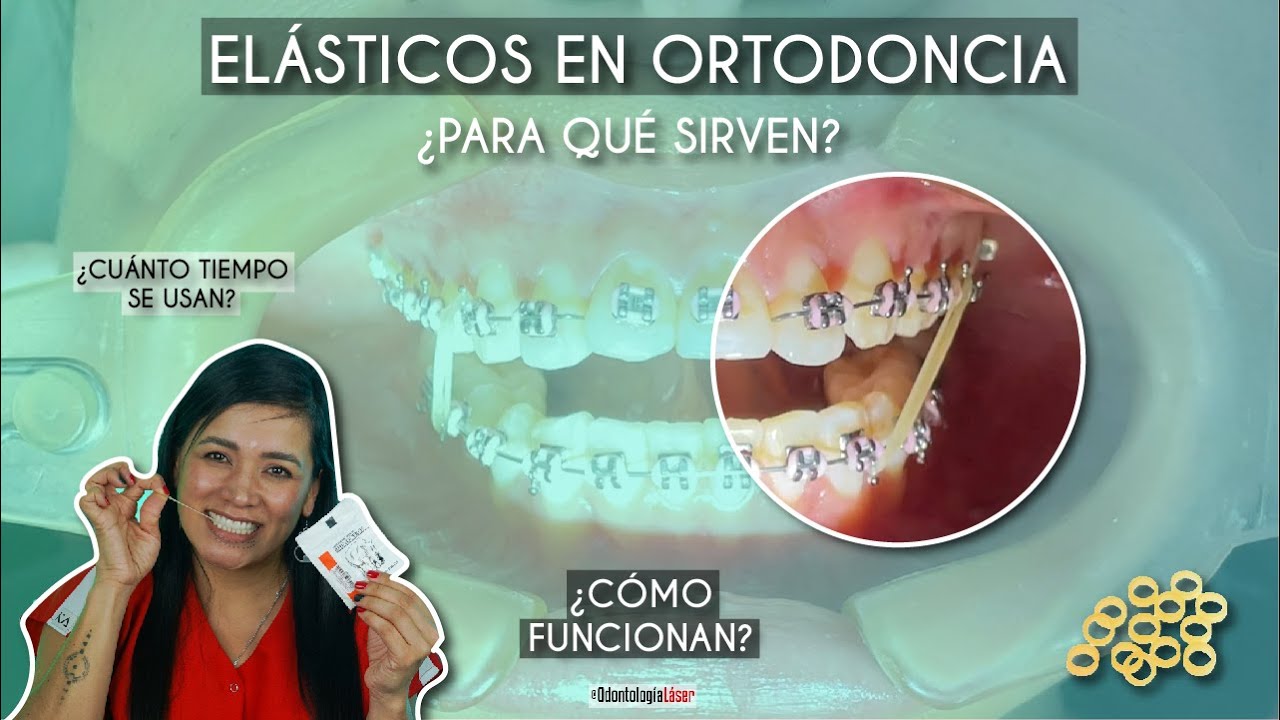 para que sirven las gomitas de los brackets