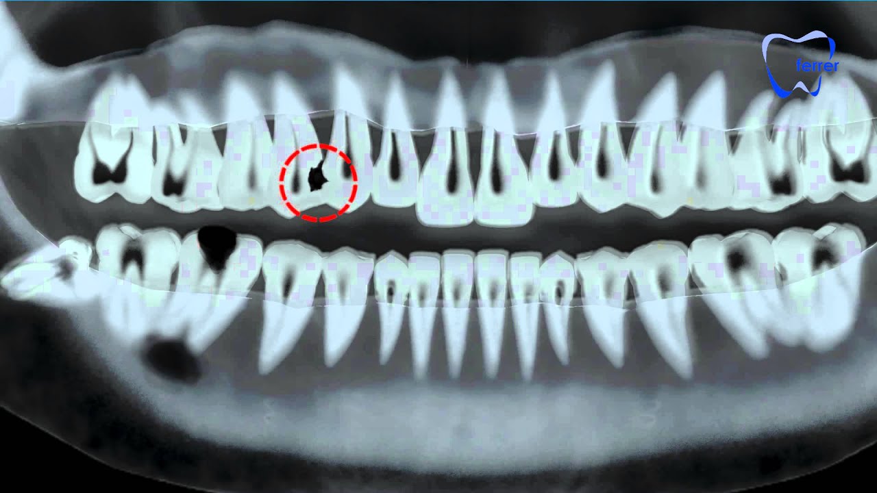 para que sirven las radiografias periapicales