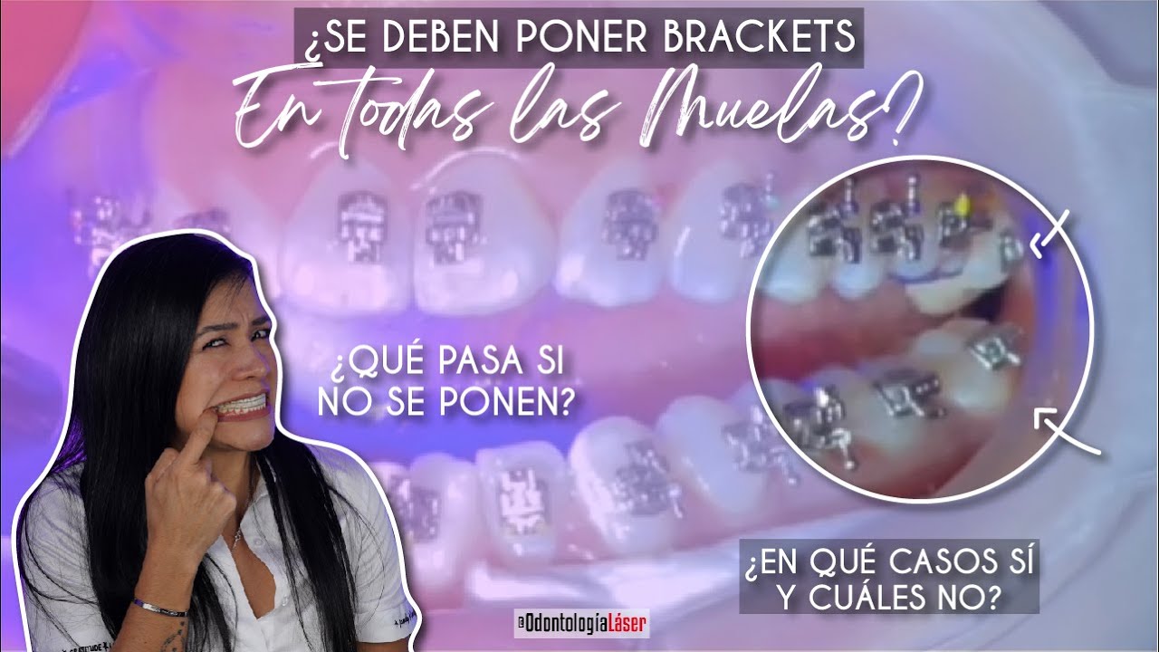 porque no ponen brackets en las últimas muelas
