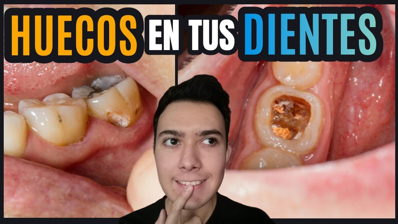 que pasa si tengo un hueco en la muela