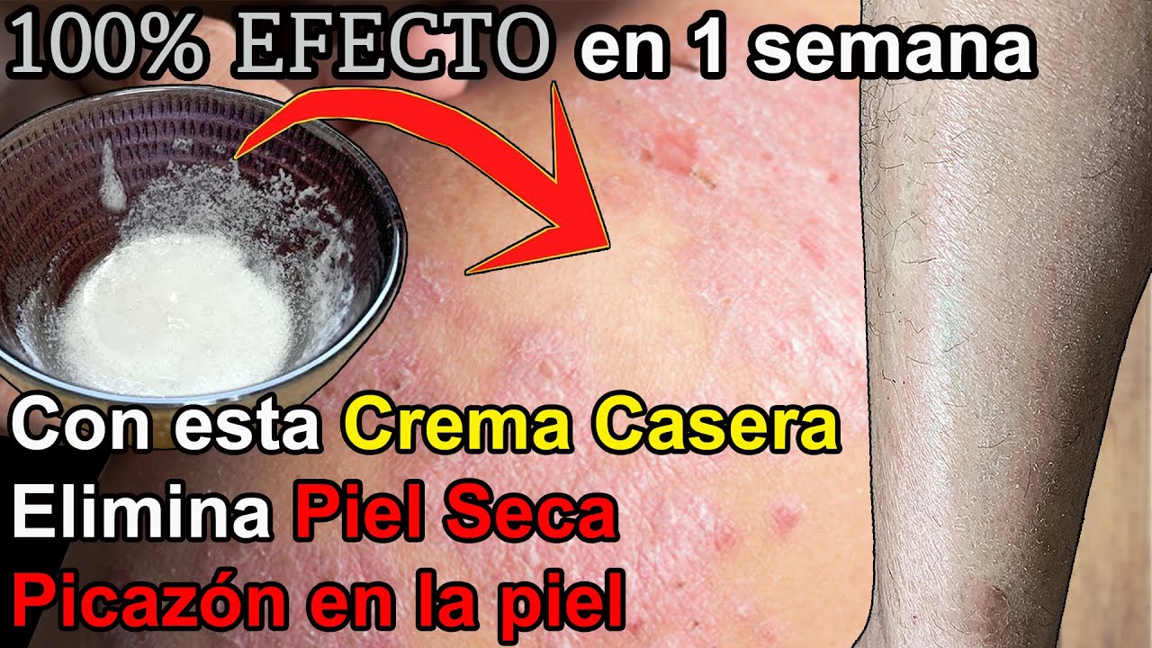 remedio casero para la piel pelada