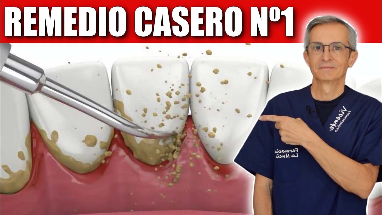 remedio caseros para el sarro en los dientes