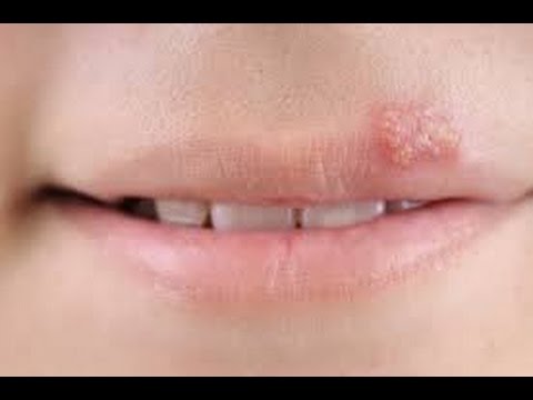 remedios caseros para herpes labial pasta de dientes